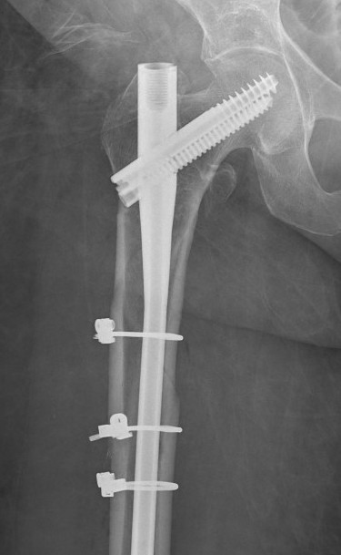 Subtrochanteric Fractures The Bone School